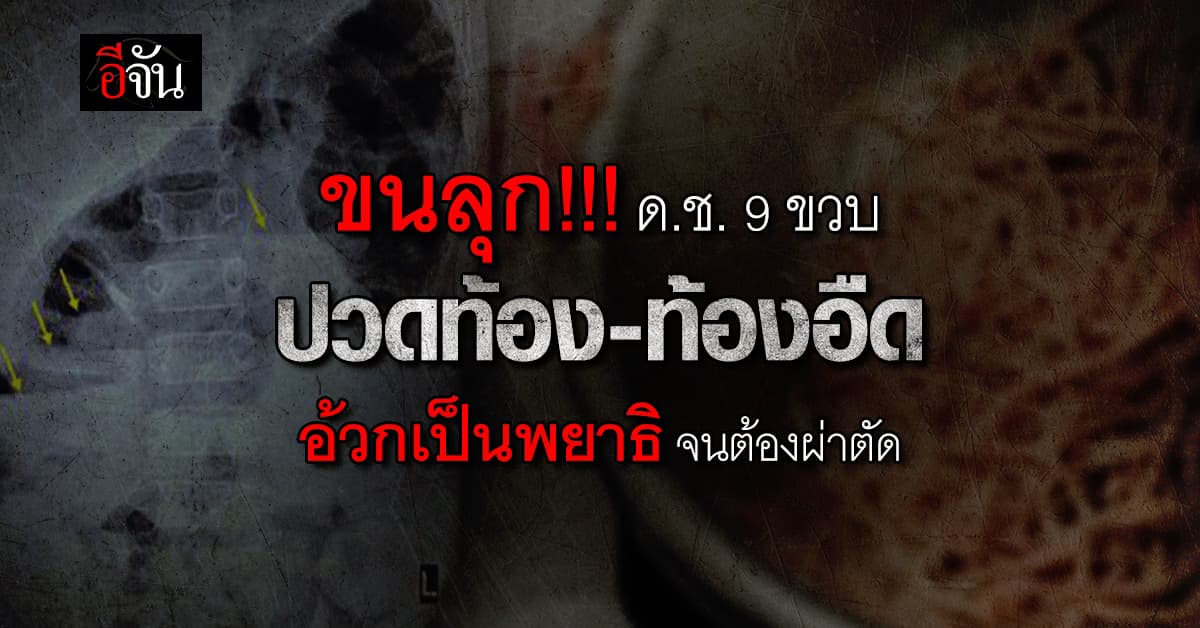 ขนลุก!!! ด.ช.ชาวมอริเชียส วัย 9 ขวบ ปวดท้อง-ท้องอืด อ้วกเป็นพยาธิ จนต้องผ่าตัด