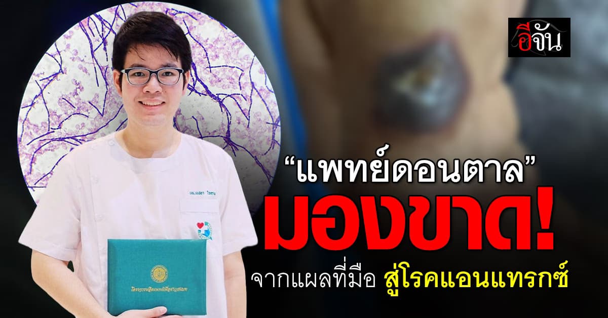 เปิดเบื้องหลัง “แพทย์ รพ.ดอนตาล” วินิจฉัยแผลที่มือ สู่ “โรคแอนแทรกซ์”