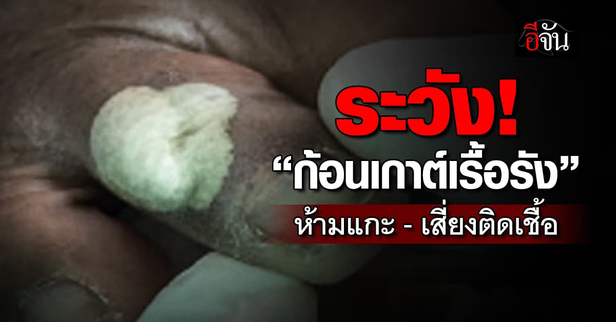 ระวัง! “ก้อนเกาต์เรื้อรัง” ห้ามแกะ – เกา เสี่ยงติดเชื้อได้