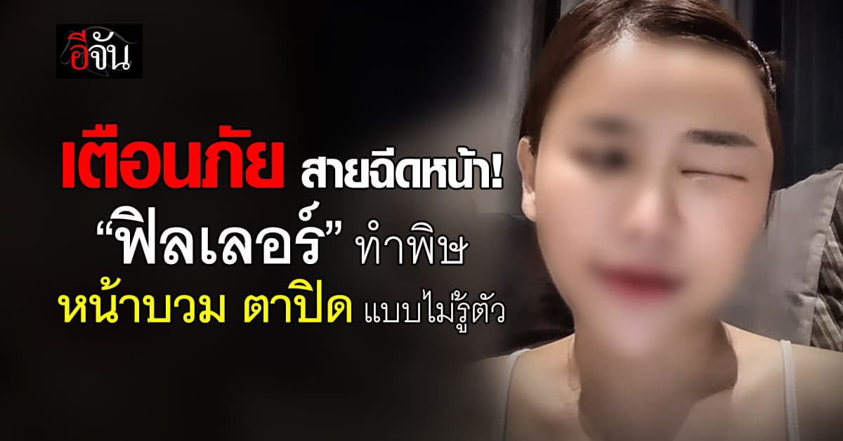อุทาหรณ์ความงาม ! สาวโพสต์คลิป แชร์ประสบการณ์ฉีดฟิลเลอร์ไร้คุณภาพ ทำหน้าบวม ตาปิด