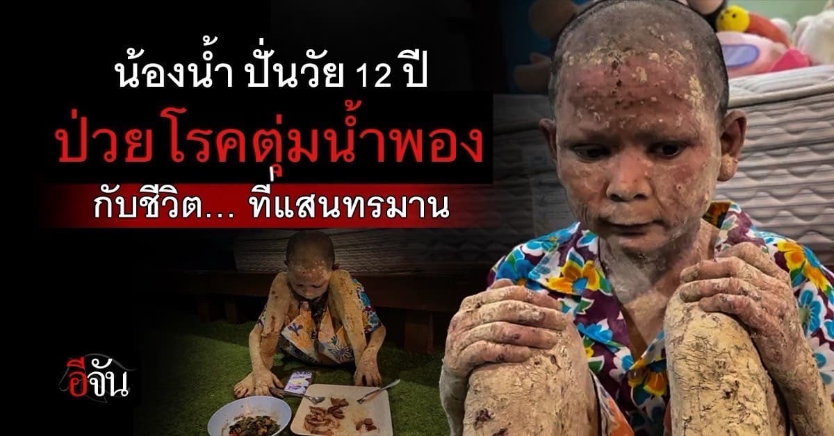 เปิดชีวิต น้องน้ำปั่น วัย 12 ปี ป่วยโรคตุ่มน้ำพอง ชีวิตแสนทรมาน