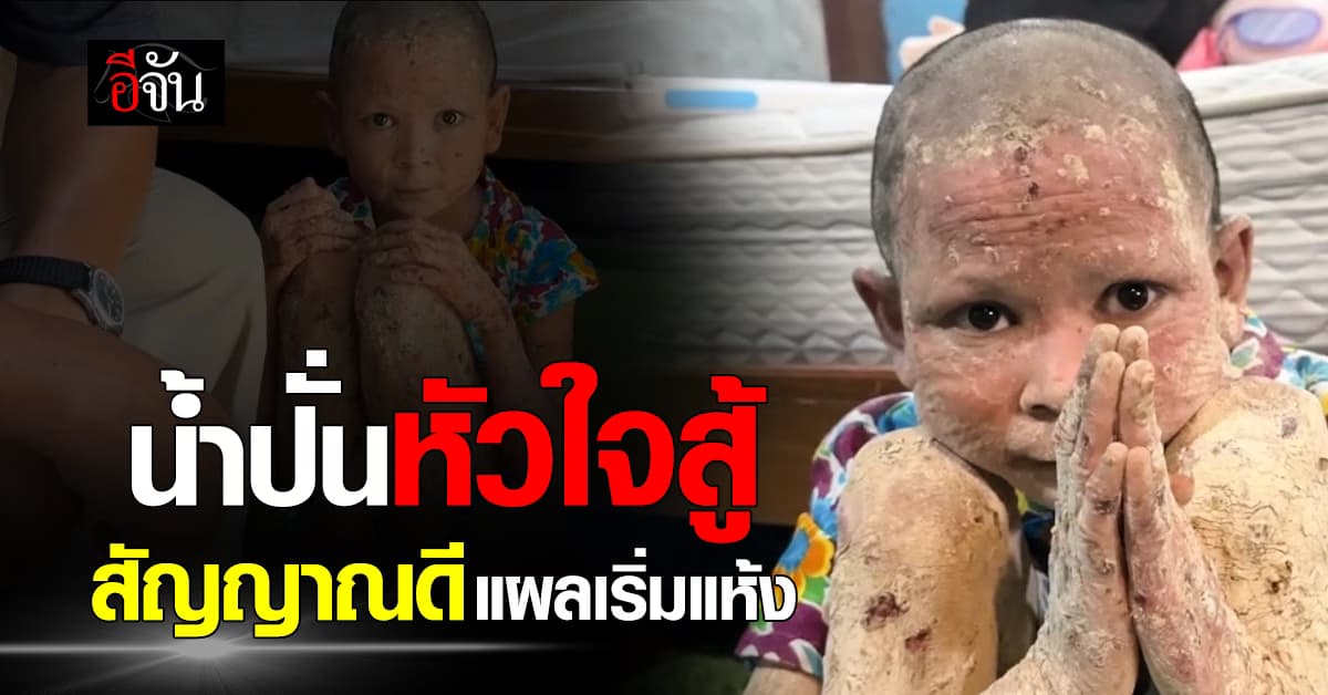 สัญญาณดี อาการน้องน้ำปั่น ป่วยตุ่มน้ำพอง แผลแห้ง สะเก็ดหลุด