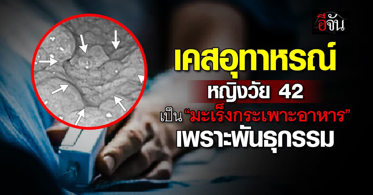 อุทาหรณ์! หญิงวัย 42 เป็น “มะเร็งกระเพาะอาหาร”เพราะพันธุกรรม