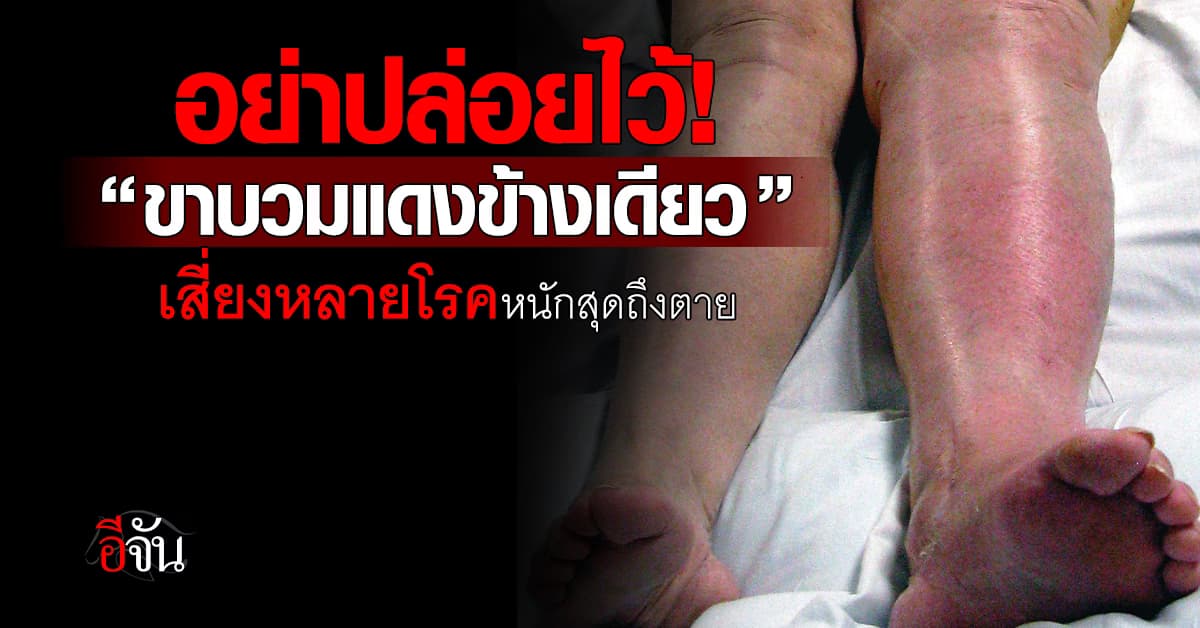อย่าปล่อยไว้! “ขาบวมแดงข้างเดียว” เสี่ยงหลายโรค หนักสุดอาจถึงตาย 