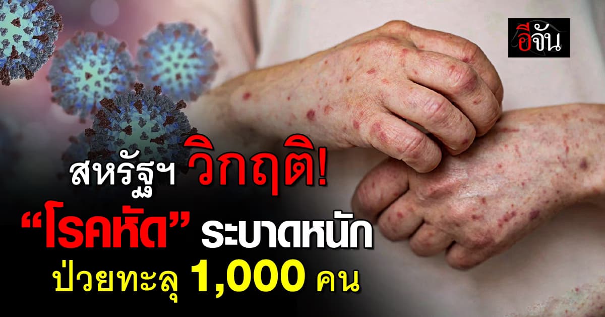 สหรัฐฯ อ่วมหนัก! ยอดผู้ป่วย “โรคหัด” พุ่งทะลุ 1,000 ราย