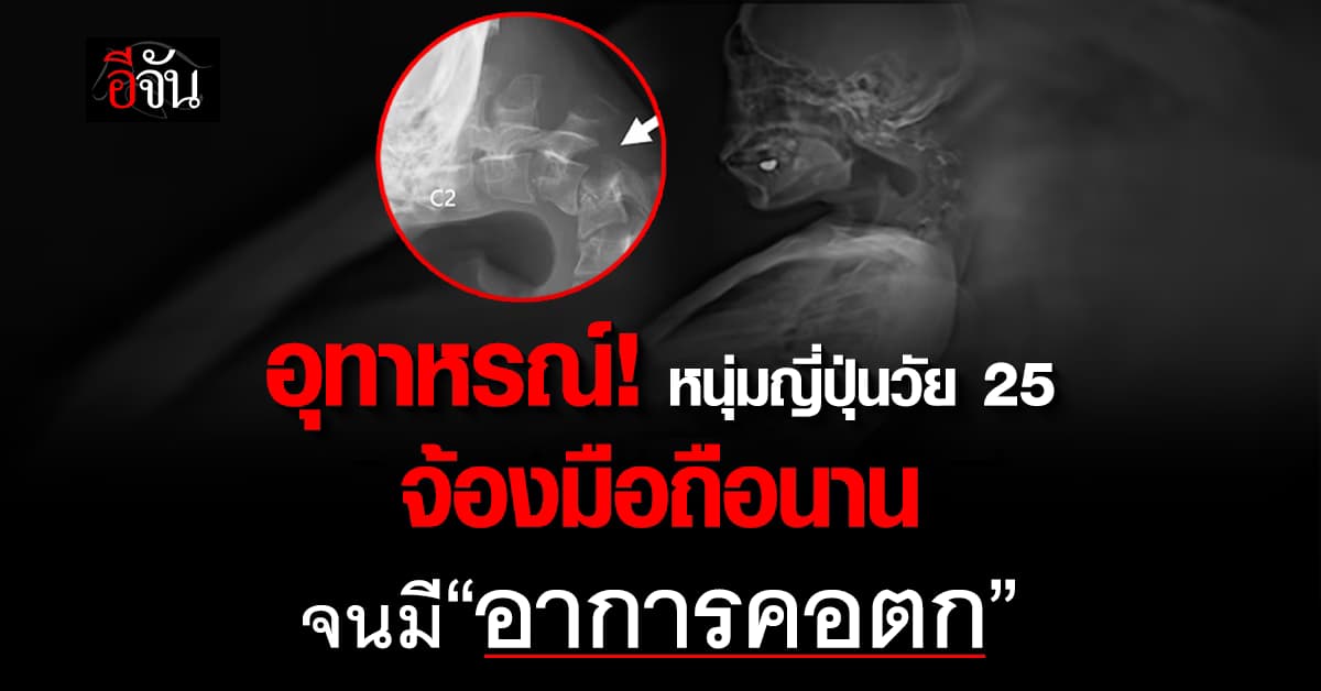 อุทาหรณ์! หนุ่มญี่ปุ่นวัย 25 จ้องมือถือนานจนมี “อาการคอตก”