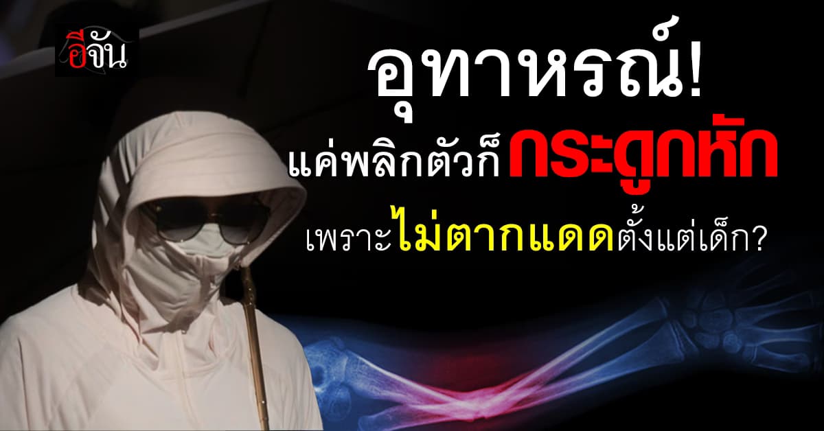 อุทาหรณ์! สาวจีน “กระดูกหัก ขณะพลิกตัว” เพราะหลีกเลี่ยงแสงแดดตั้งแต่เด็ก