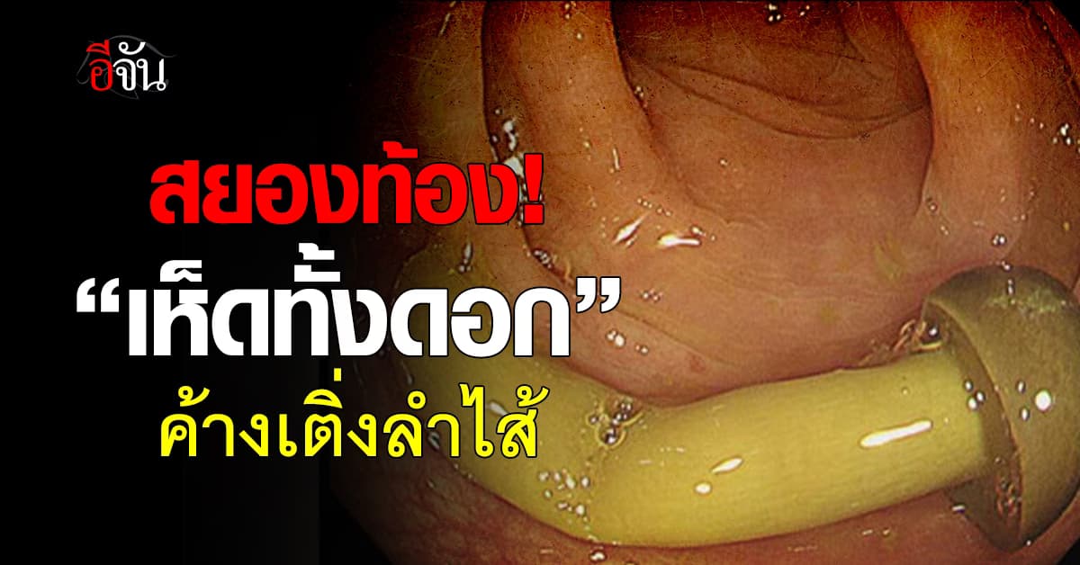 ขนลุก! เปิดภาพ “เห็ดทั้งดอก” ค้างในลำไส้