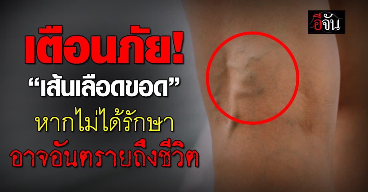 เตือนภัย! “เส้นเลือดขอด” ไม่ใช่เรื่องเล่น หากเป็นต้องรีบรักษาทันที   