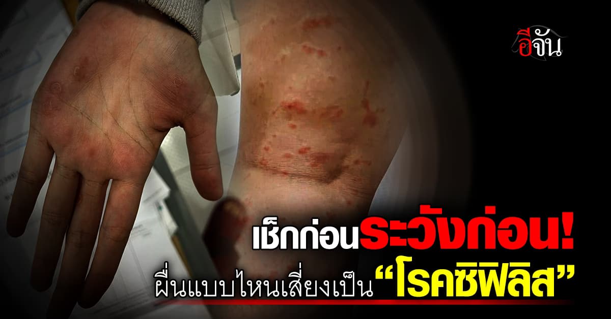 ระวัง! ผื่นแบบไหน บ่งบอกว่า กำลังเสี่ยงเป็น “โรคซิฟิลิส” 