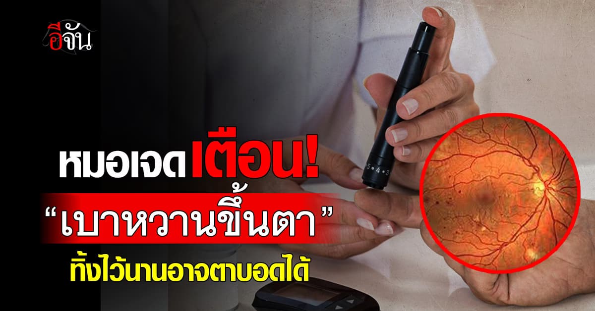 เตือนภัย! “เบาหวานขึ้นตา” ต้องรีบรักษาทิ้งไว้นานอาจตาบอดได้ 