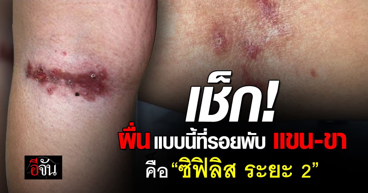 เช็ก! หากร่างกายมีผื่นที่รอยพับ อาจเสี่ยงเป็น “ซิฟิลิส ระยะ 2” ได้ 