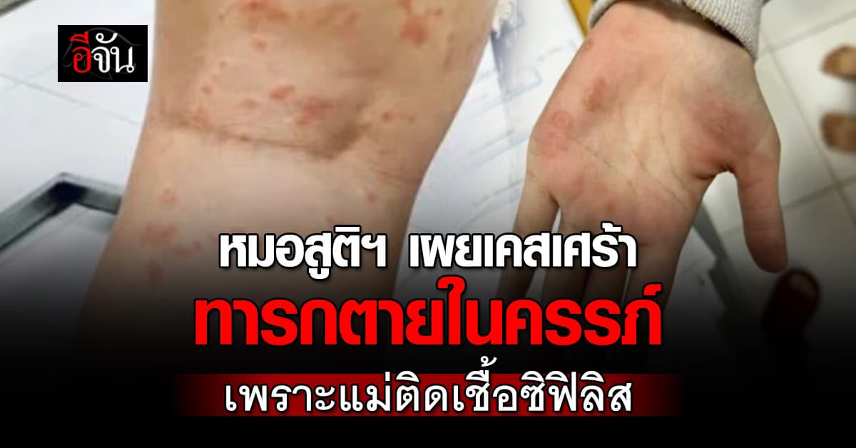 หมอสูติฯ เผยเคสเศร้า ทารกตายในครรภ์ เพราะแม่ติดเชื้อซิฟิลิส 