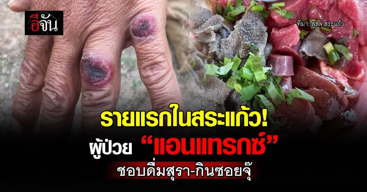 รายแรกในสระแก้ว! พบผู้ป่วย “แอนแทรกซ์” ชอบดื่มสุรา-กินซอยจุ๊ 