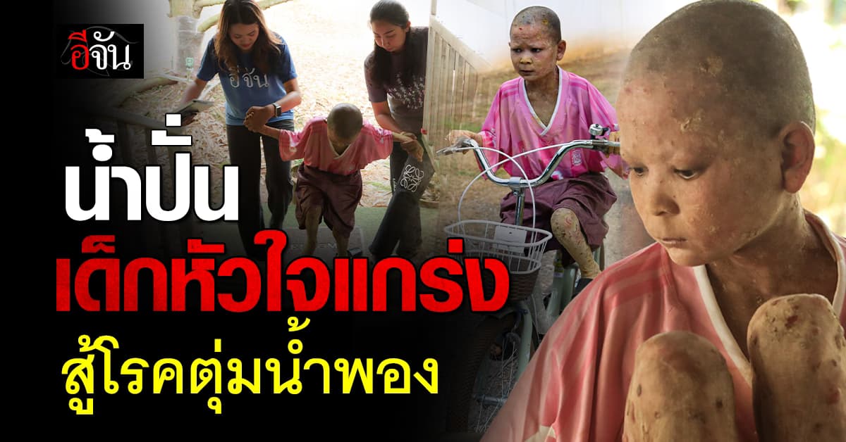 อัพเดท อาการน้องน้ำปั่น เด็กหญิงหัวใจแกร่ง ป่วยโรคสะเก็ดเงิน