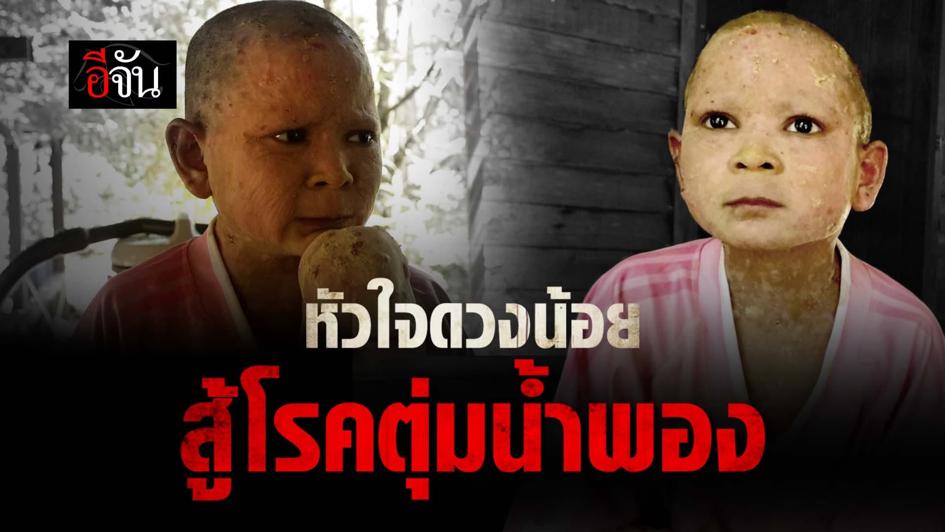 🎬 หัวใจดวงน้อย สู้โรคตุ่มน้ำพอง