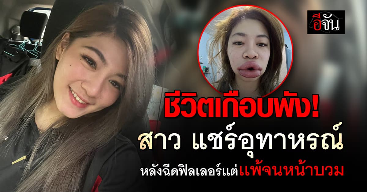อุทาหรณ์! สาว แชร์ประสบการณ์ ฉีดฟิลเลอร์เเต่ตัวเองเกิดเเพ้จนหน้าบวม   