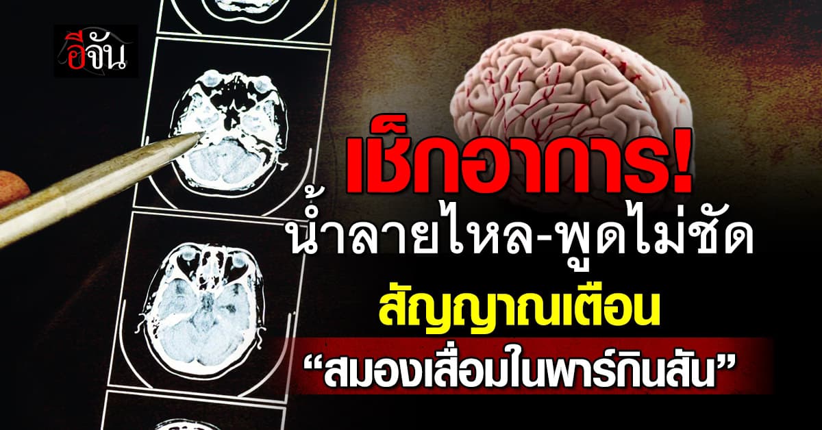 เช็กด่วน! น้ำลายไหล-พูดไม่ชัด เป็นสัญญาณเตือน “สมองเสื่อมในพาร์กินสัน”