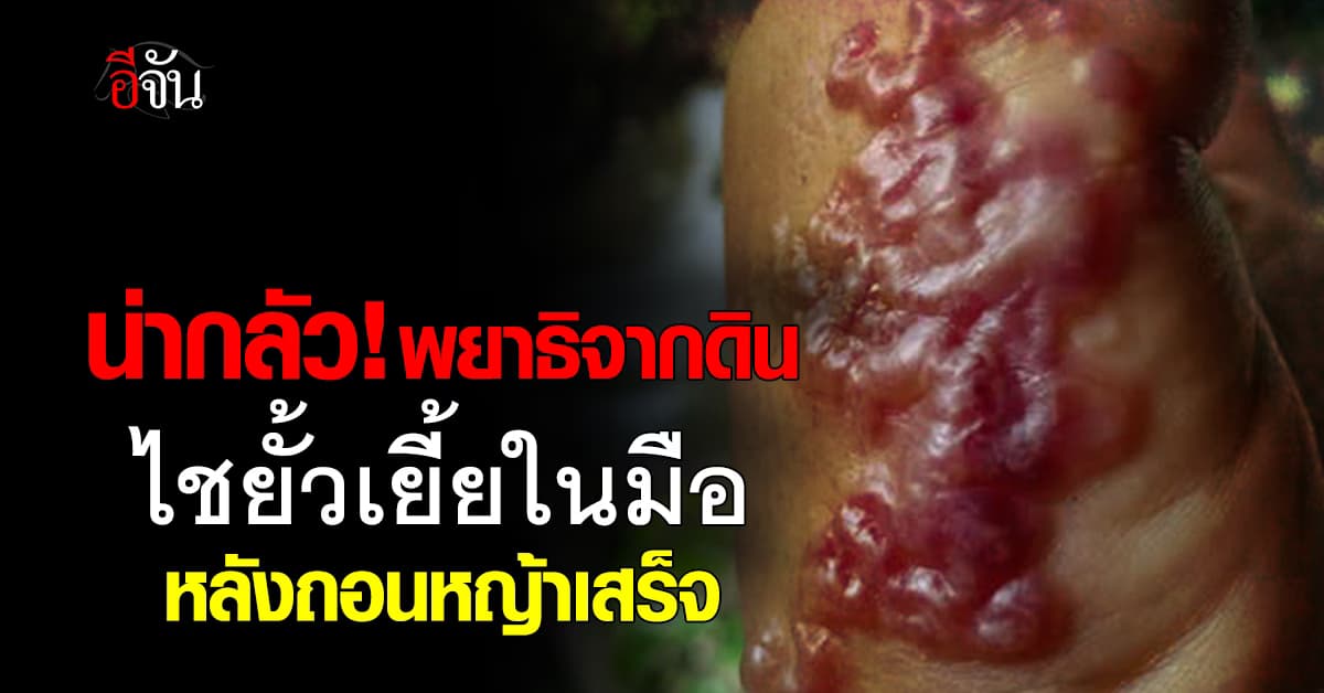 สาวแชร์อุทาหรณ์! พยาธิจากดินไชมือ หลังถอนหญ้าเสร็จ