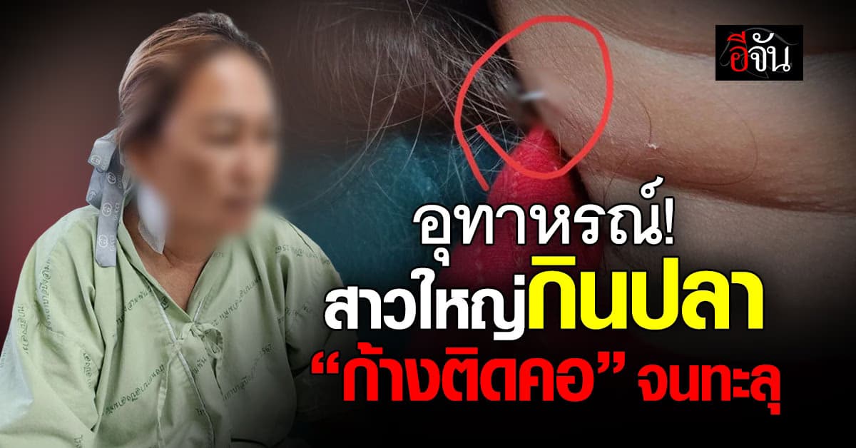 อุทาหรณ์! “ก้างติดคอ” ก่อนแทงทะลุ หลังผ่านไปกว่า 2 สัปดาห์ 