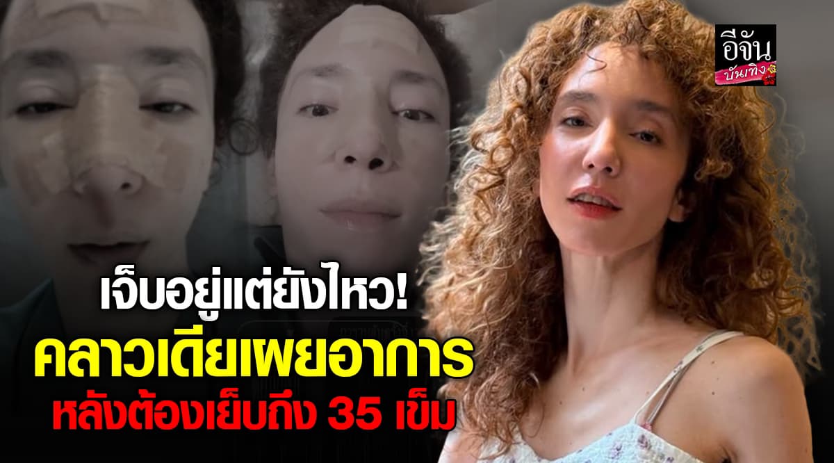 เจ็บแต่สู้! คลาวเดีย เผยภาพแผลสด อัปเดตอาการล่าสุด หลังวูบล้มแรงหัวฟาดพื้น