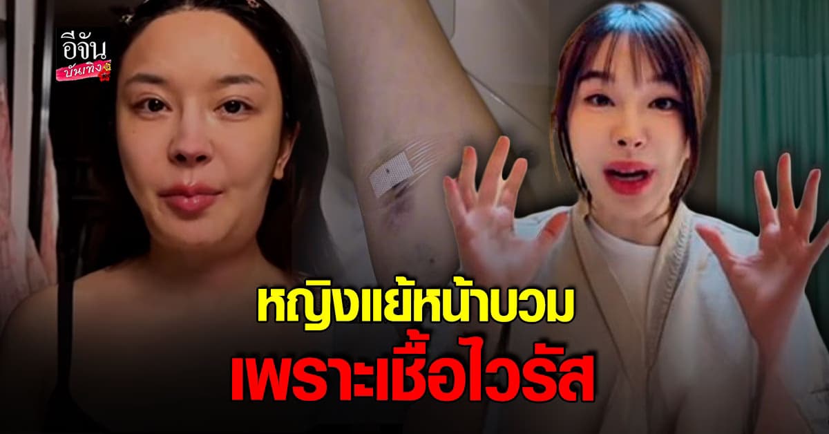 หญิงแย้ อัปเดตอาการหน้าบวม สรุปเป็นเชื้อไวรัส ไม่ใช่มะเร็ง