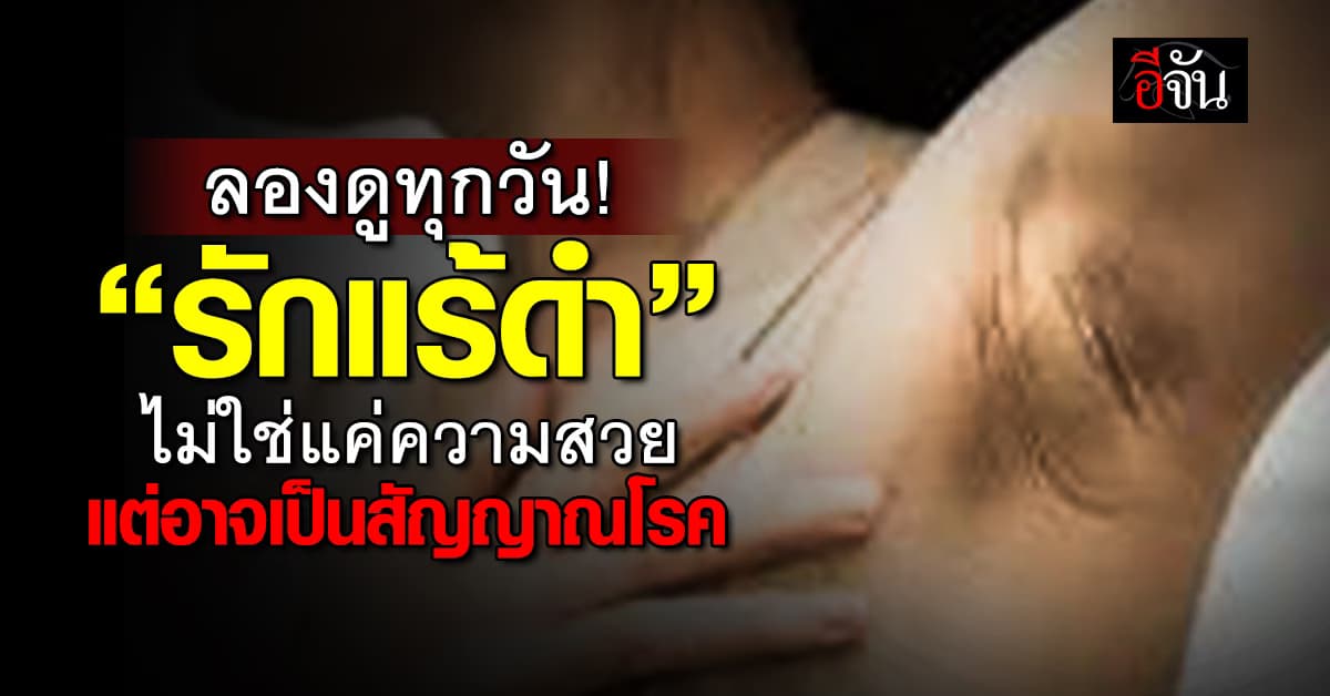 หมอหมู ตอบชัด! “รักแร้ดำ” ไม่เกี่ยวกับความสวย แต่อาจเป็นสัญญาณของโรค 
