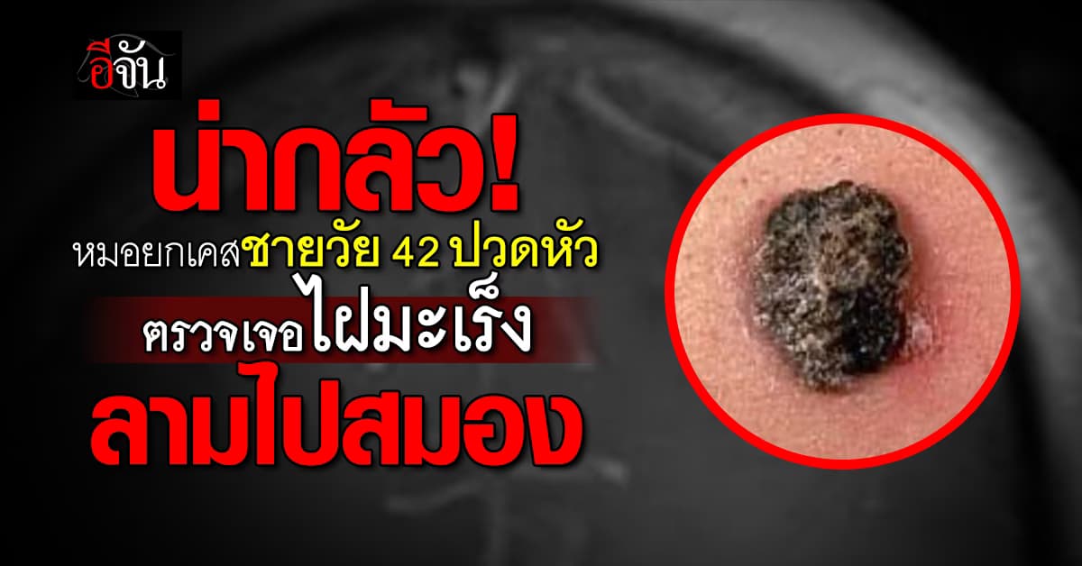 น่ากลัว! ปวดหัว ตรวจเจอไฝมะเร็ง ลามไปสมอง