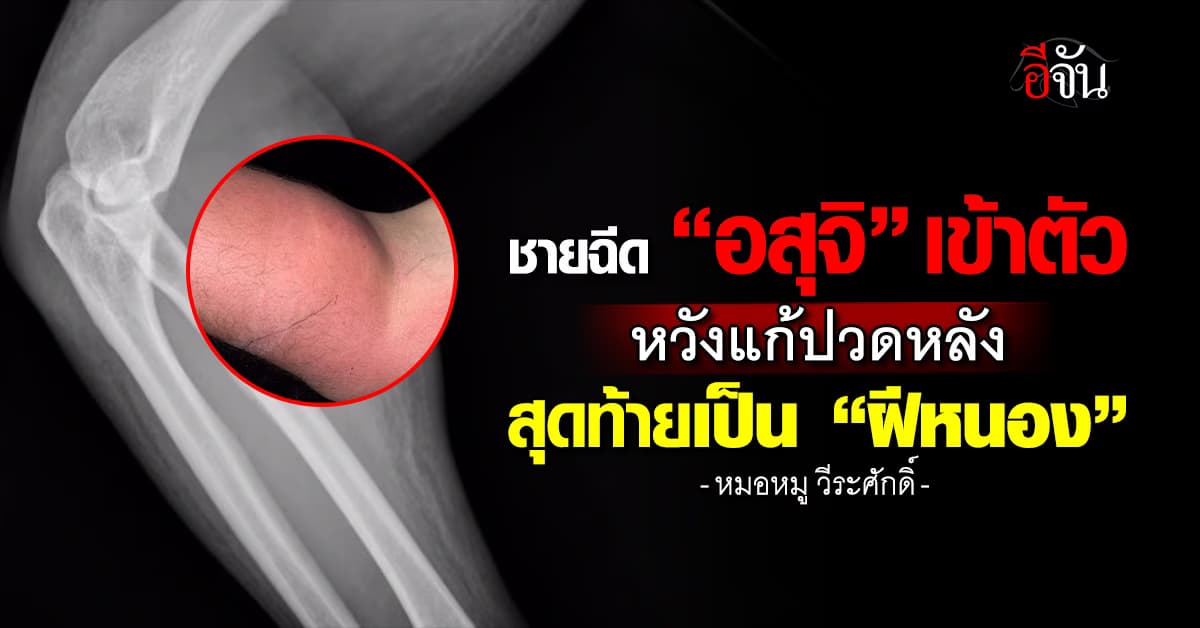 ฉีด “อสุจิ” เข้าร่างกาย หวังแก้ปวดหลัง สุดท้ายเป็น “ฝีหนอง”