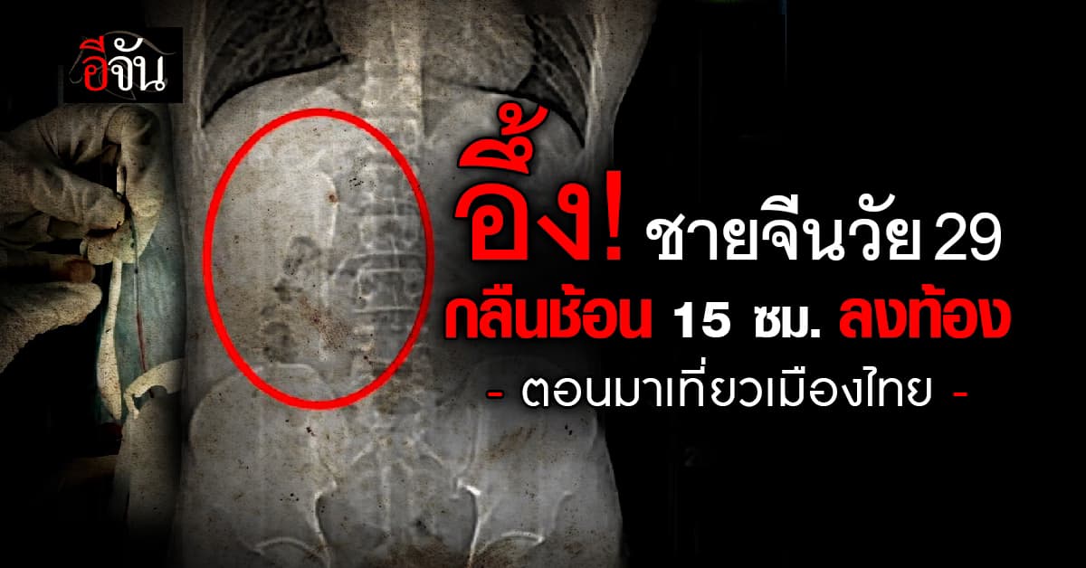 ชายชาวจีน กลืนช้อนลงท้อง เพราะเมาไม่รู้สติ