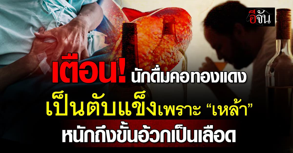เตือน! นักดื่มคอทองแดง กินเหล้าจนเป็นตับแข็ง อาการหนักถึงขั้นกระอักเลือด 