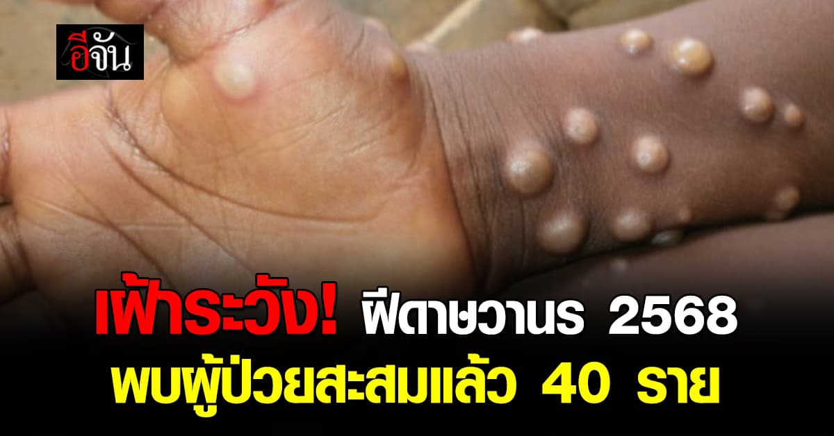 รัฐบาล เตือน “ฝีดาษวานร” 2568 พบผู้ป่วยสะสมแล้ว 40 ราย