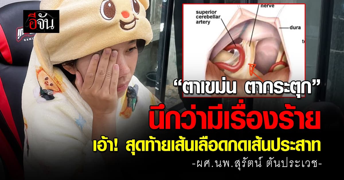 หมอสุรัตน์ ยกเคสคนไข้ “ตาเขม่น ตากระตุก” สุดท้ายเส้นเลือดกดเส้นประสาท