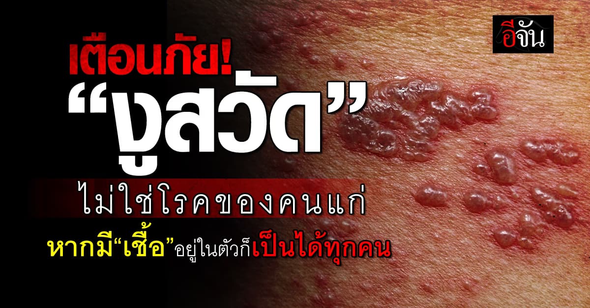 เตือน! “งูสวัด” ไม่ใช่โรคของคนแก่ ถ้ามี “เชื้อ” ซ่อนอยู่ในตัวก็เป็นได้ 