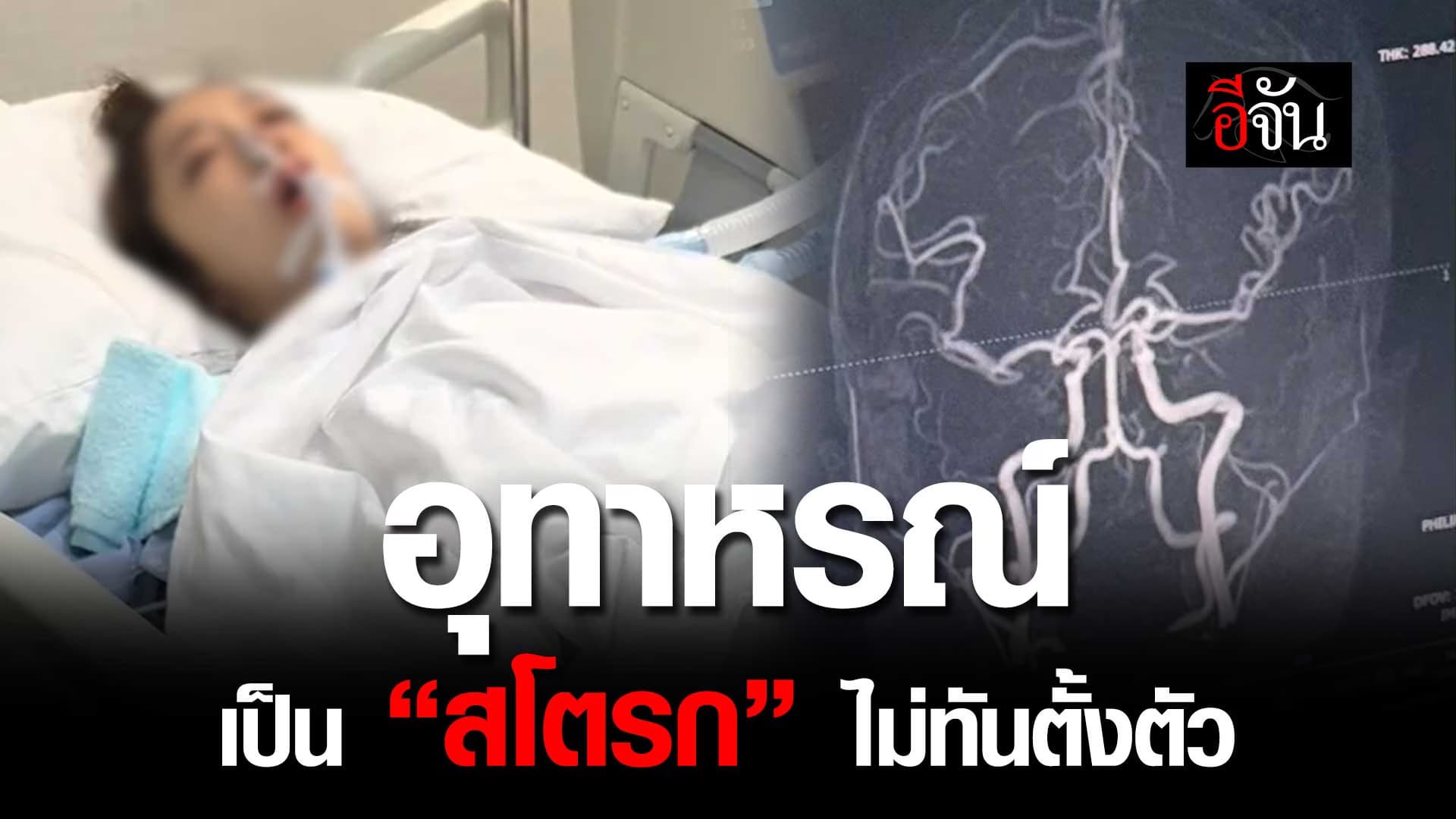 🎬 อุทาหรณ์ เป็น “สโตรก” ไม่ทันตั้งตัว