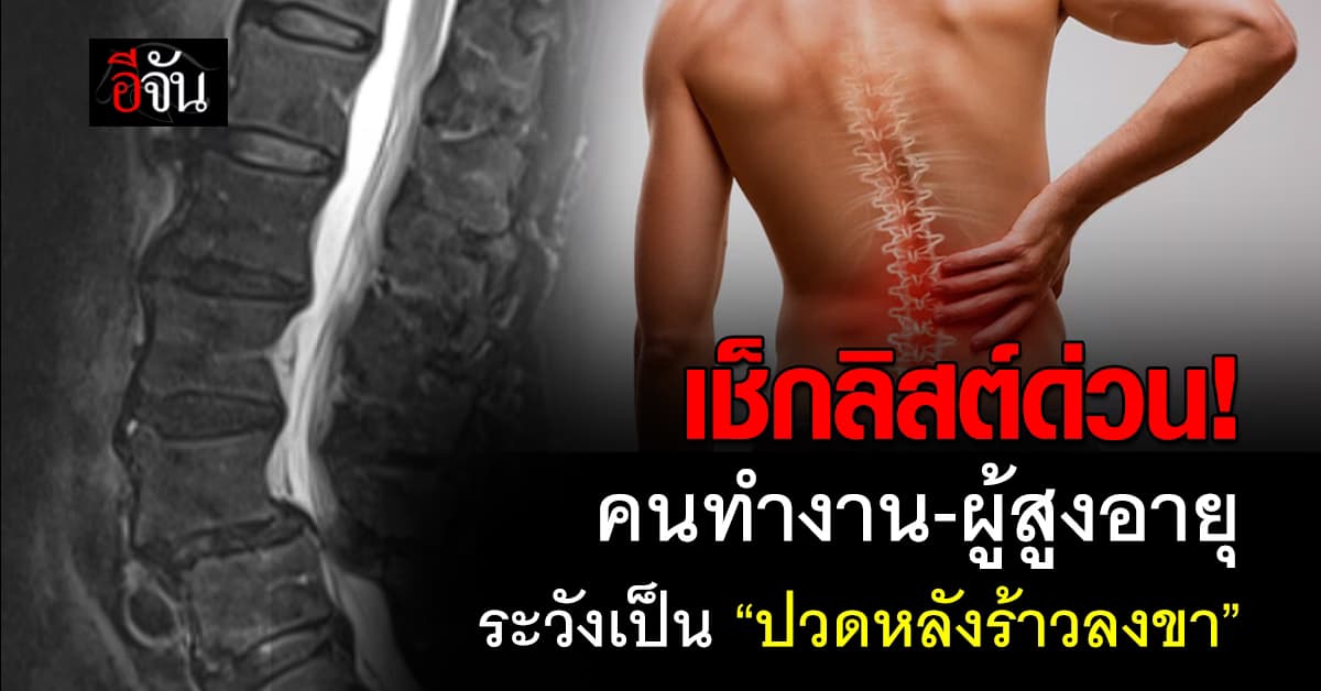 วางใจไม่ได้! แพทย์ เตือน “ปวดหลังร้าวลงขา” สามารถเป็นได้ทุกคน 
