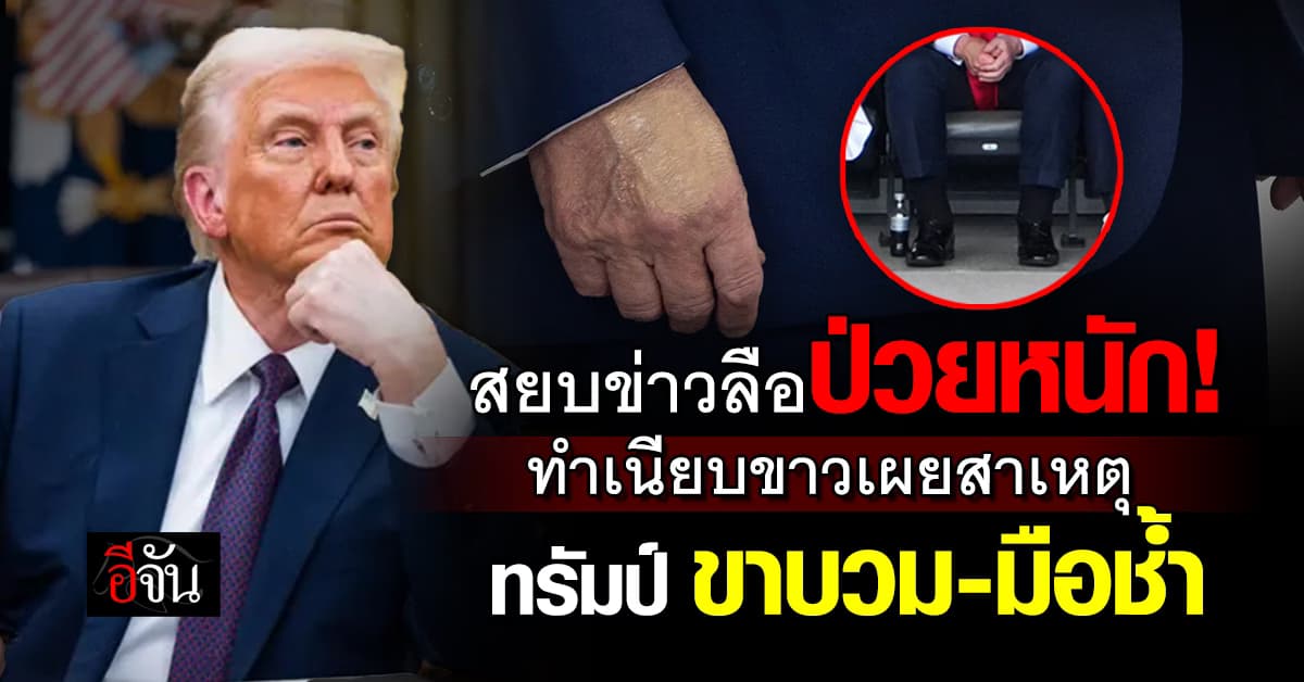 สยบข่าวลือป่วยหนัก! ทำเนียบขาว เผยสาเหตุ ทรัมป์ ขาบวม-มือช้ำ  