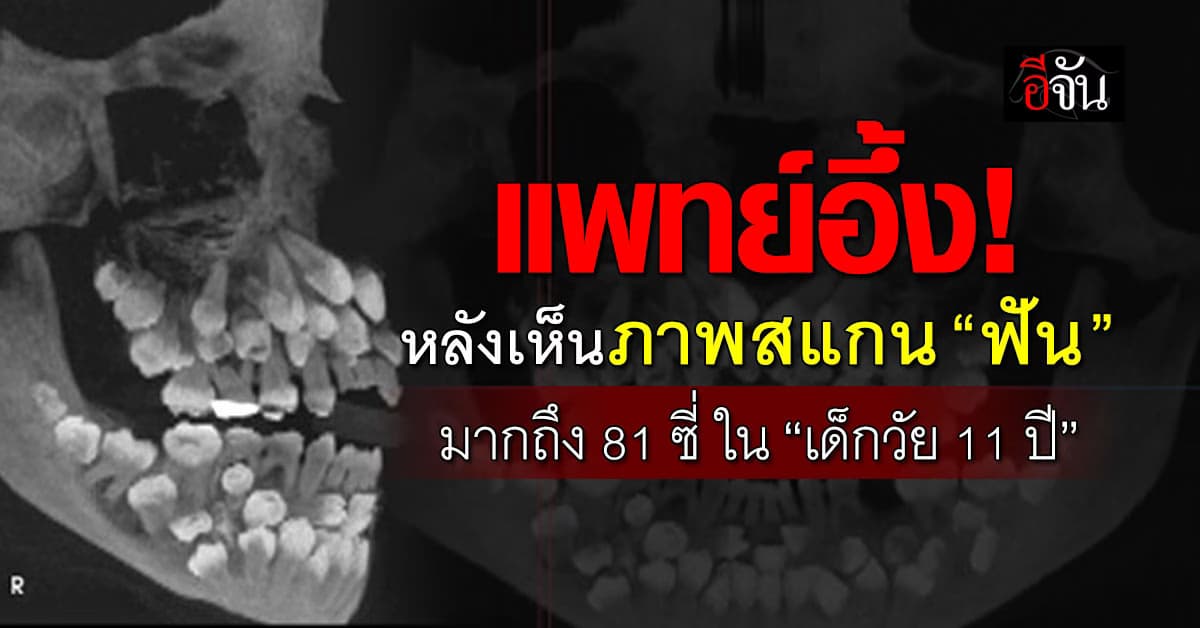 อึ้งสิแบบนี้! แพทย์ถึงกับงง เด็กบราซิลวัย 11 ปี มี “ฟัน” มากถึง 81 ซี่ 