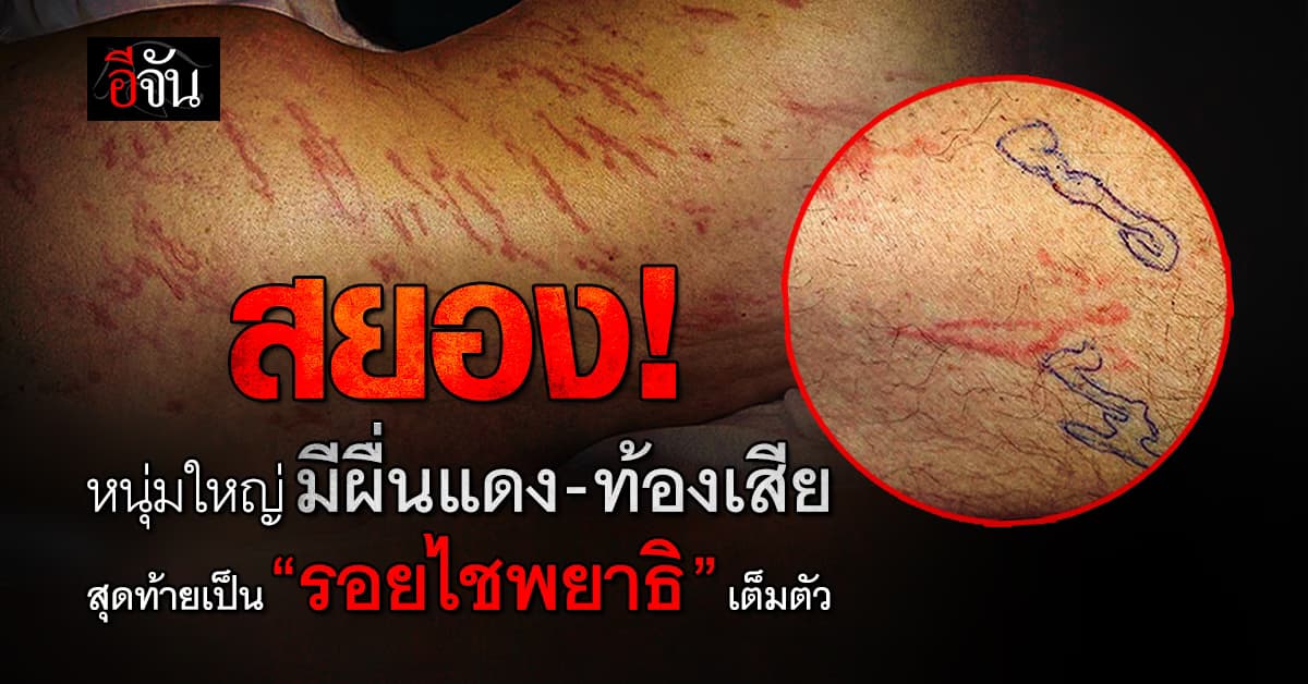 หนุ่มใหญ่ มีผื่นแดง-ท้องเสีย สุดท้ายพยาธิไชเต็มตัวจนเป็นรอย  