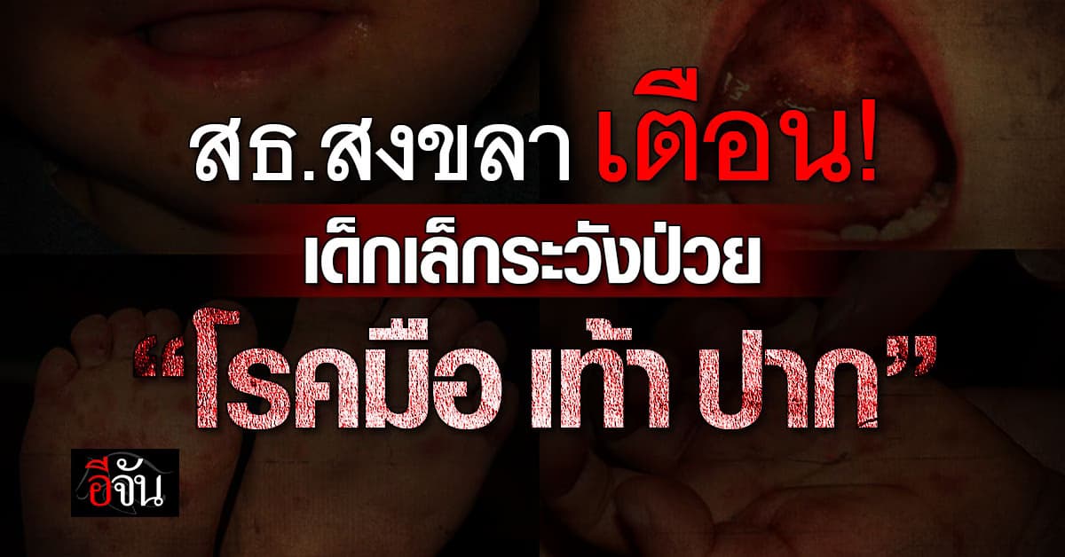 สคร.12 สงขลา เตือน ระวังป่วย “โรคมือ เท้า ปาก” ที่พบบ่อยในเด็กเล็ก 