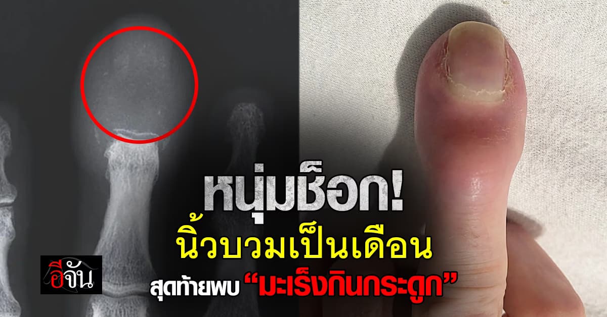ชายออสซี่นิ้วบวม 1 เดือน สุดท้ายพบ “มะเร็งกินกระดูก”