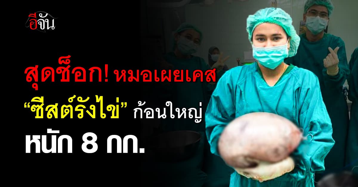 สุดช็อก! หมอสูติฯ เผยเคสผ่าตัด “ซีสต์รังไข่” ก้อนใหญ่ หนัก 8 กก. 
