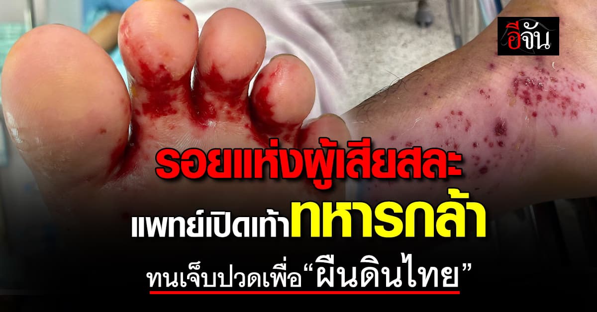 แพทย์เปิดเท้า “ทหารกล้า” เจ็บปวดเพื่อผืนดินไทย