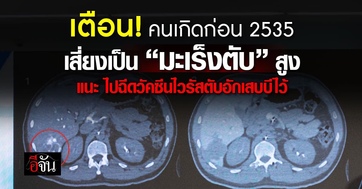 รพ. แนะ! คนเกิดก่อนปี 2535 ให้เข้ารับวัคซีนป้องกันไวรัสตับอักเสบบี