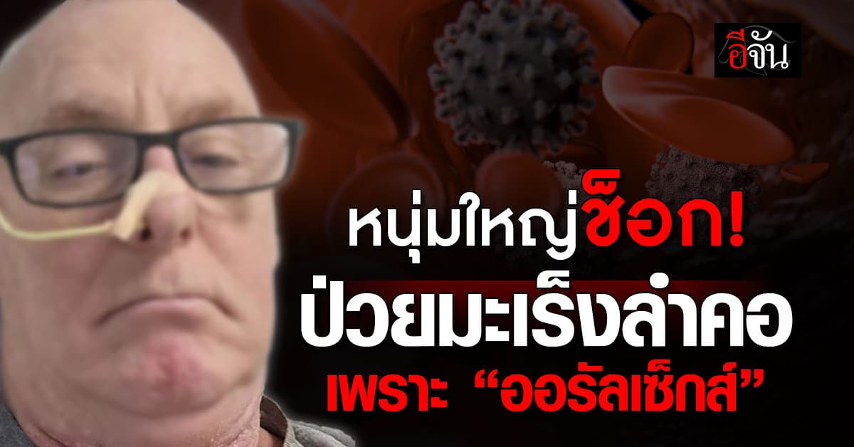 แพทย์แจง หนุ่มคอบวม ป่วยมะเร็งลำคอ เพราะ “ออรัลเซ็กส์”