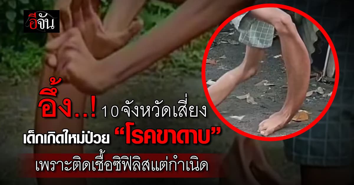 เตือน! เด็กเกิดใหม่ที่ติดเชื้อซิฟิลิสแต่กำเนิด มีโอกาสเป็น “โรคขาดาบ”  