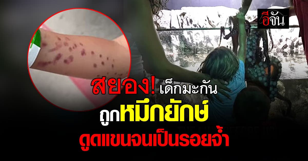 สยองเกิน! เด็กมะกันวัย 6 ขวบ ถูกปลาหมึกยักษ์ดูดแขนจนเป็นรอยจ้ำน่ากลัว  