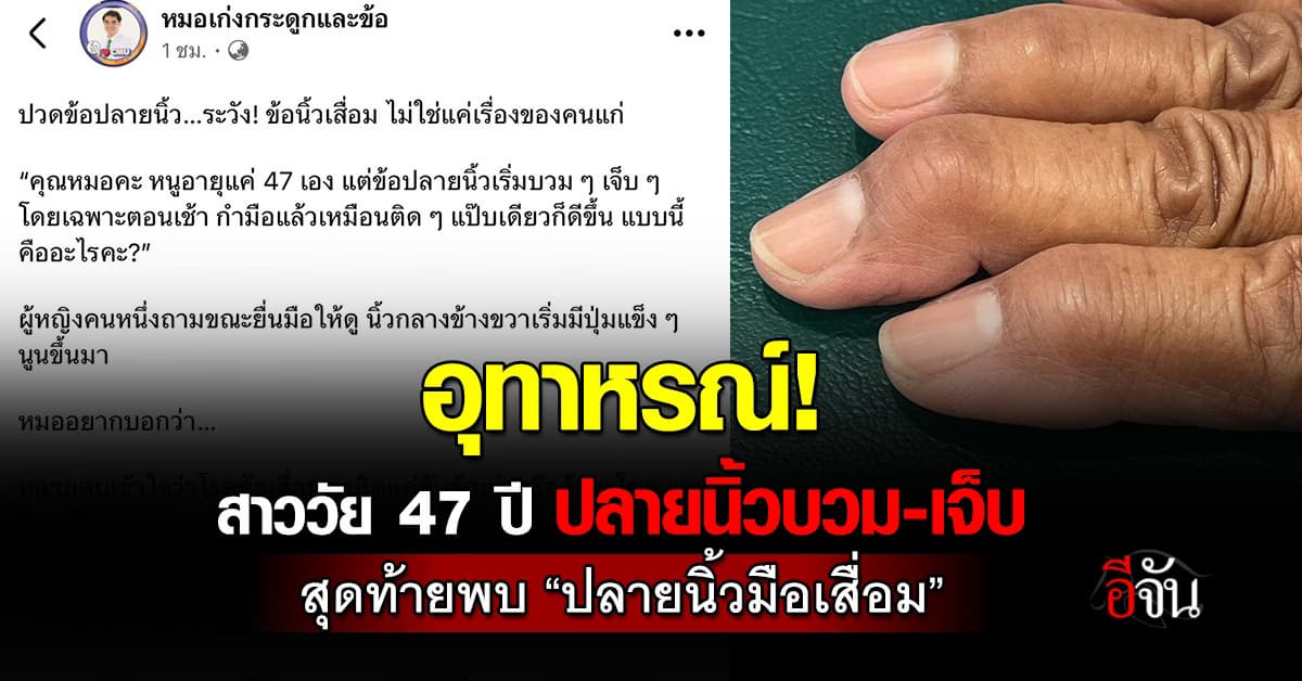 อุทาหรณ์! สาวเกิดปลายนิ้วบวม-กำมือแล้วติดๆ พบ “ข้อปลายนิ้วมือเสื่อม” 