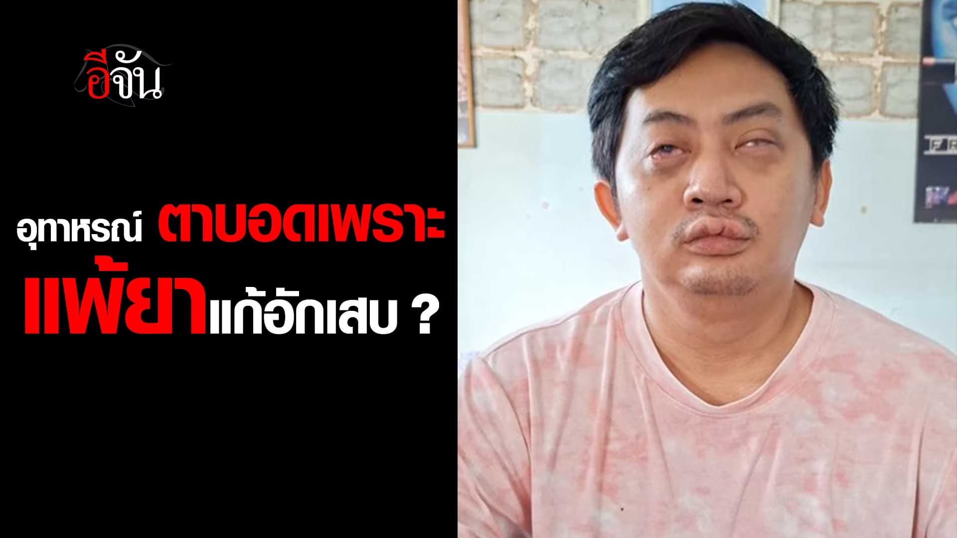 🎬 อุทาหรณ์ ตาบอด เพราะแพ้ยาแก้อักเสบ ?