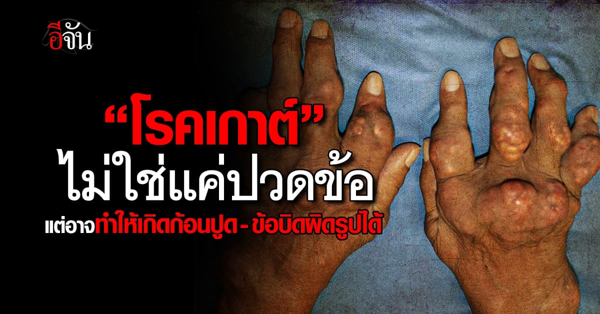 ป้องกัน! “โรคเกาต์”อาจทำให้เกิดก้อนปูด-ข้อบิดผิดรูปได้ 